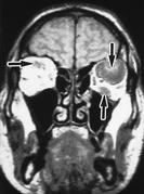 Fig. 8 ­ Coupes coronales. Séquence IRM 	  pondérée en T1 après injection de produit de contraste